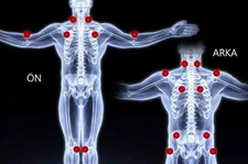 Fibromiyalji Noktaları