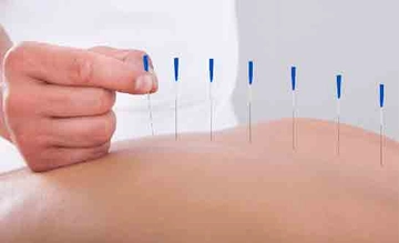 Fibromiyalji Kuru İğne Tedavisi Nedir ve Nasıl Yapılır?